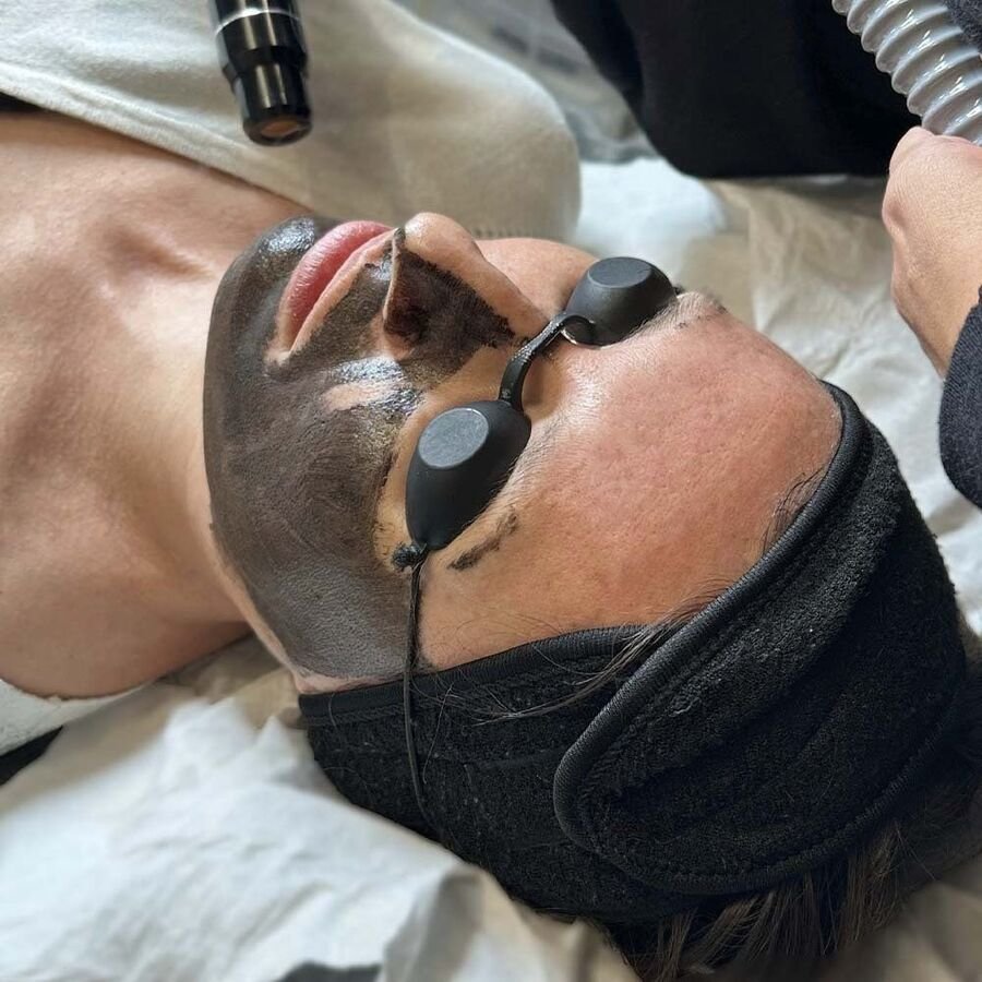 Tratamiento Hollywood Peel con láser