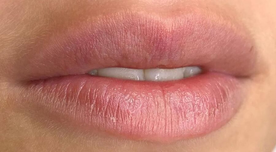 Labios sin pigmento antes del procedimiento